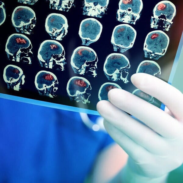 How to Pay Medical Bills During a Brain Injury Lawsuit